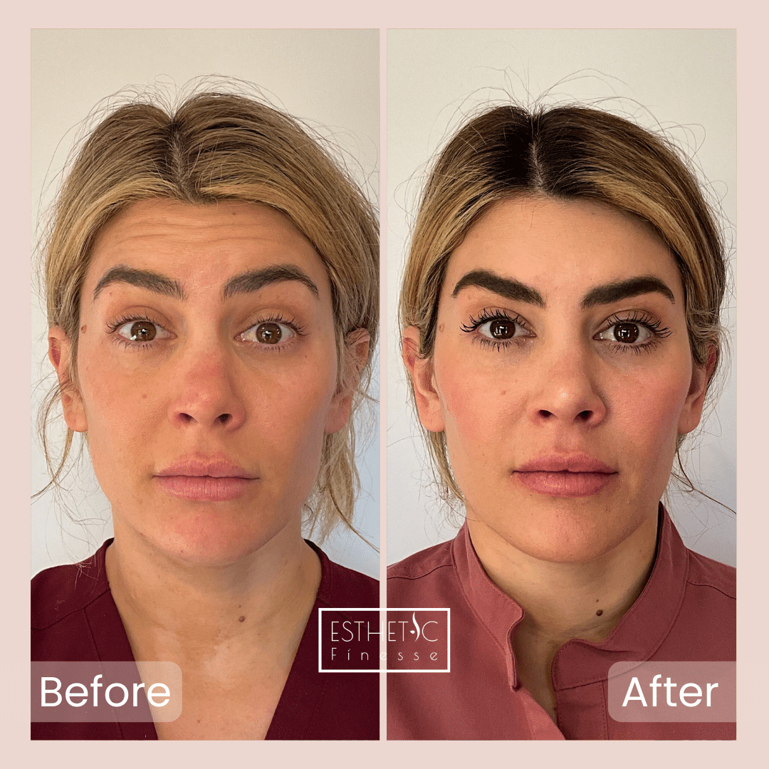 Natural Botox wrinkle reduction on forehead - Phoenix client