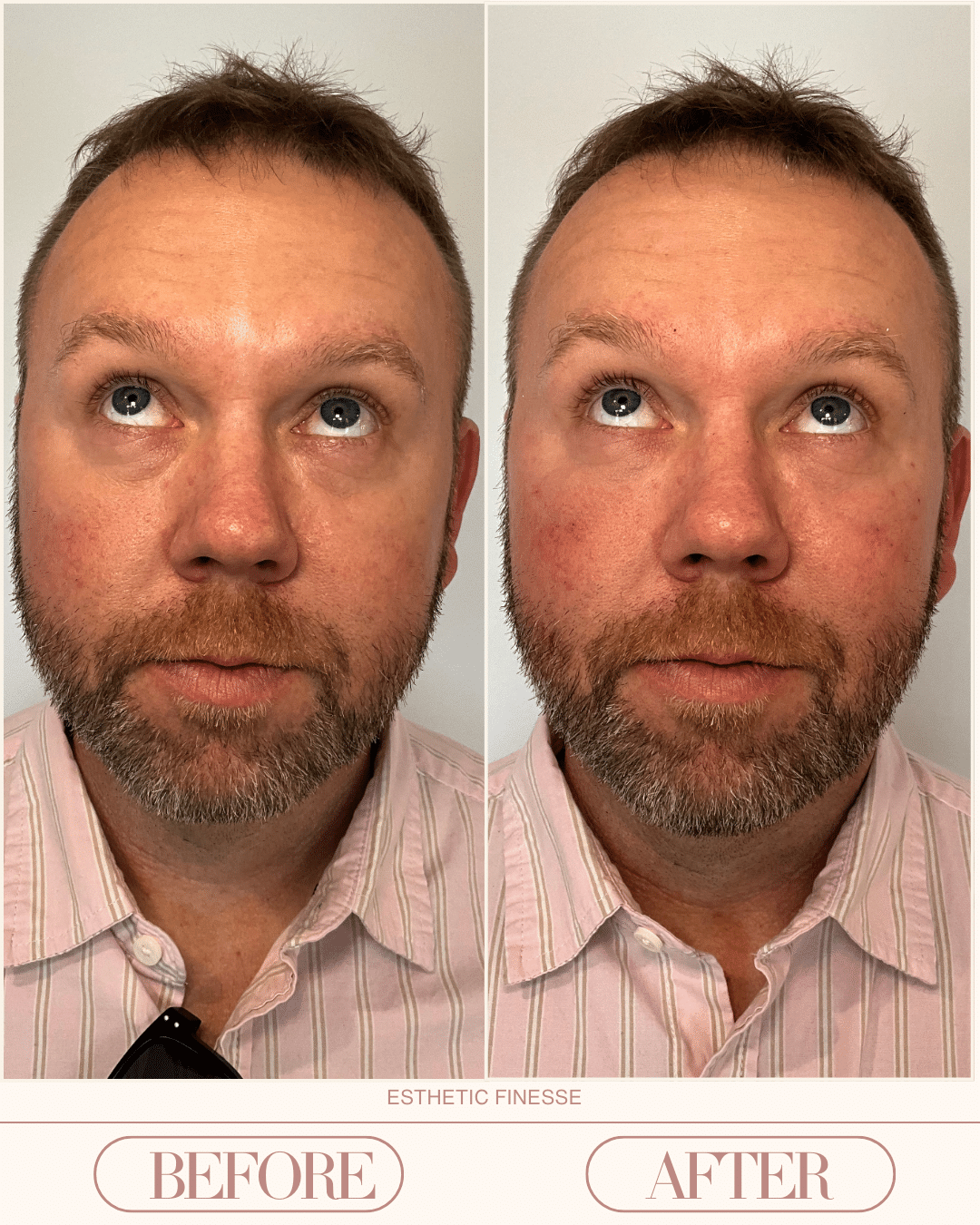 under eye filler