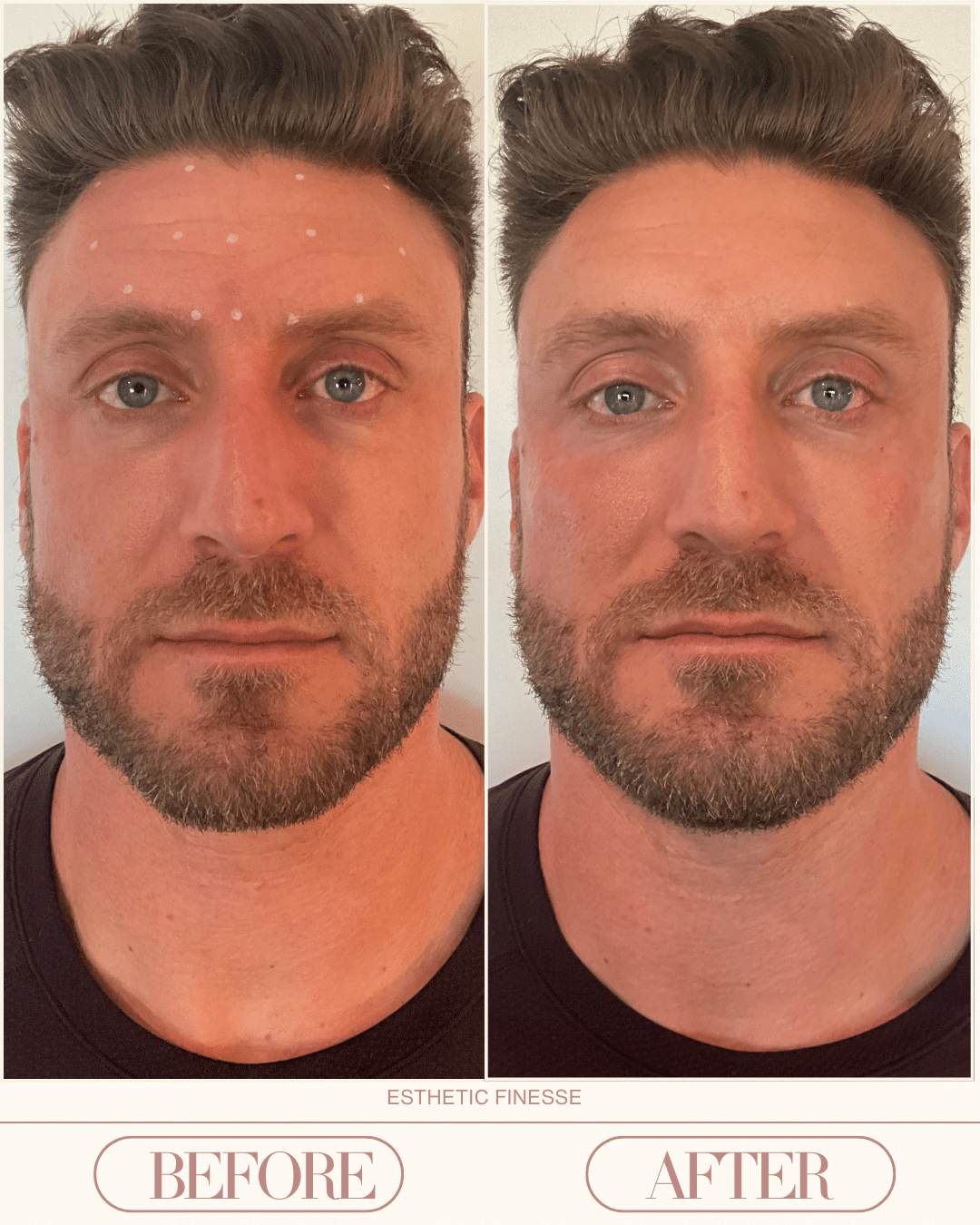 under eye filler