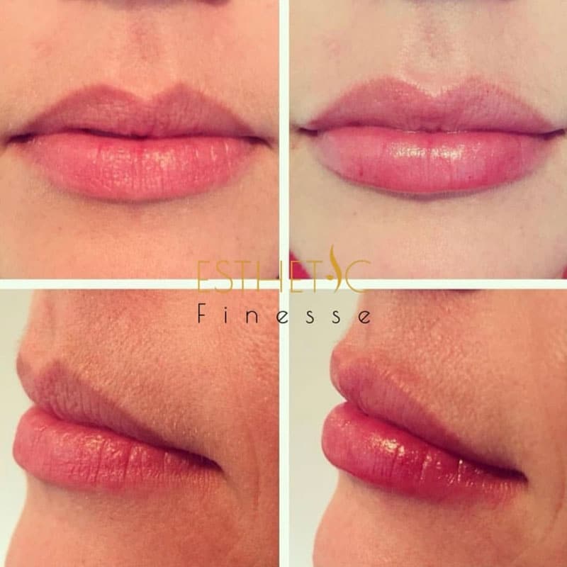Esthetic Finesse Services From Botox In Scottsdale to Lip Filler Arizona