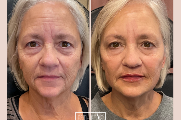 Happy Botox client after treatment in Phoenix clinic