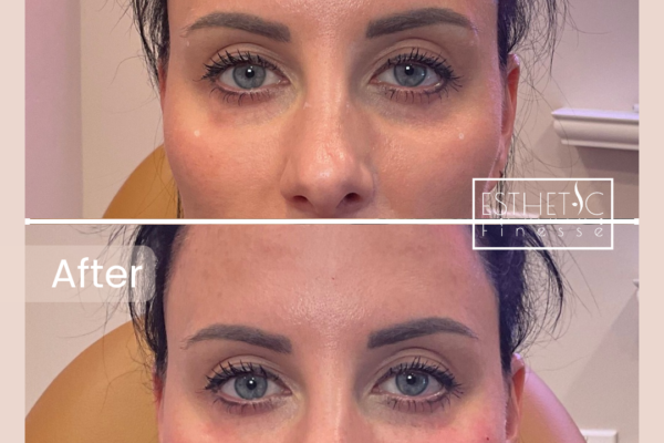 Kristine Basile's Undereye_20250103_040007_0000 Kristine Basile's Undereye_20250103_040007_0000