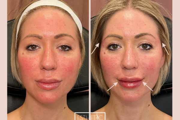 Restylane Kysse | Soft volume with enhanced profile projection