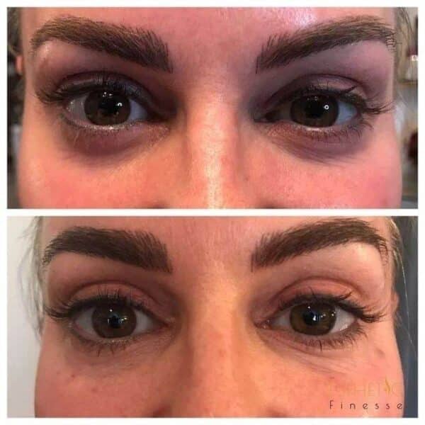 Under Eye Filler Scottsdale