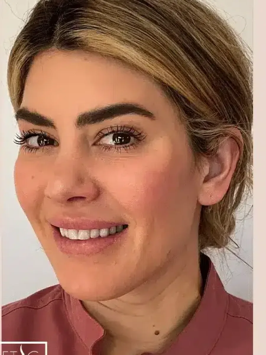 Crow’s Feet & Brow after — Esthetic Finesse