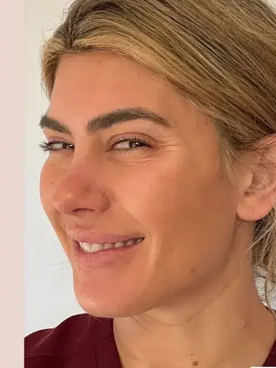 Crow’s Feet & Brow before — Esthetic Finesse