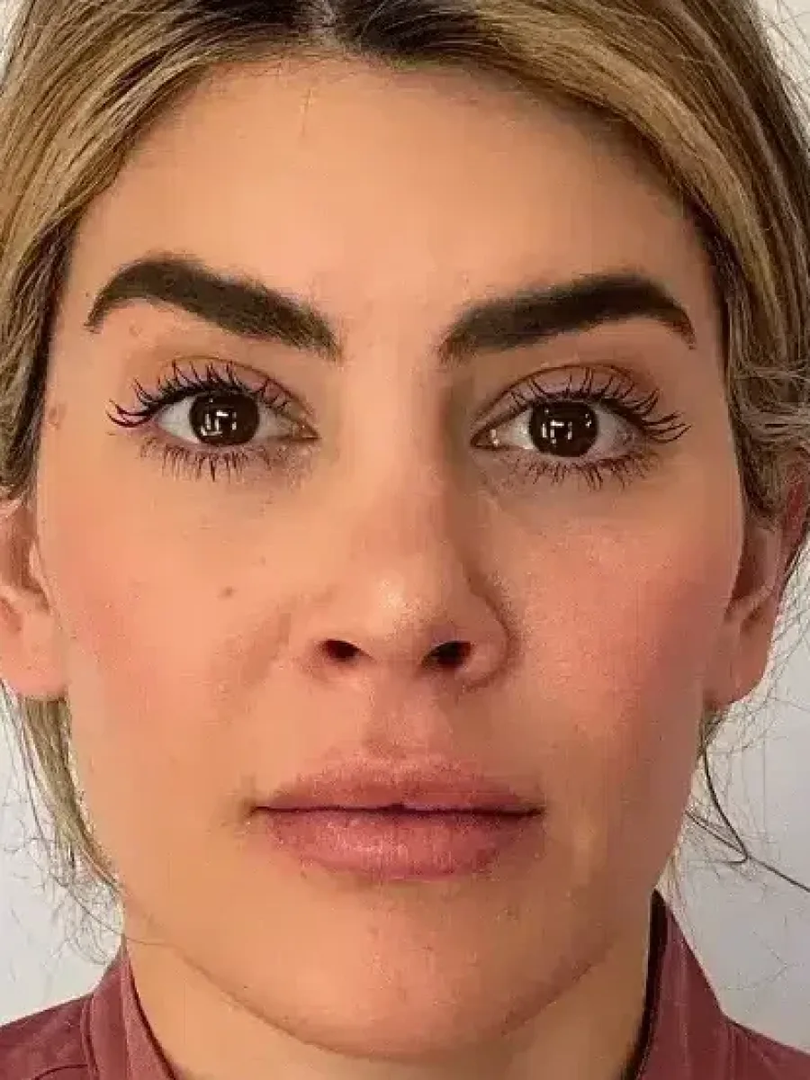Natural Softening after — Esthetic Finesse