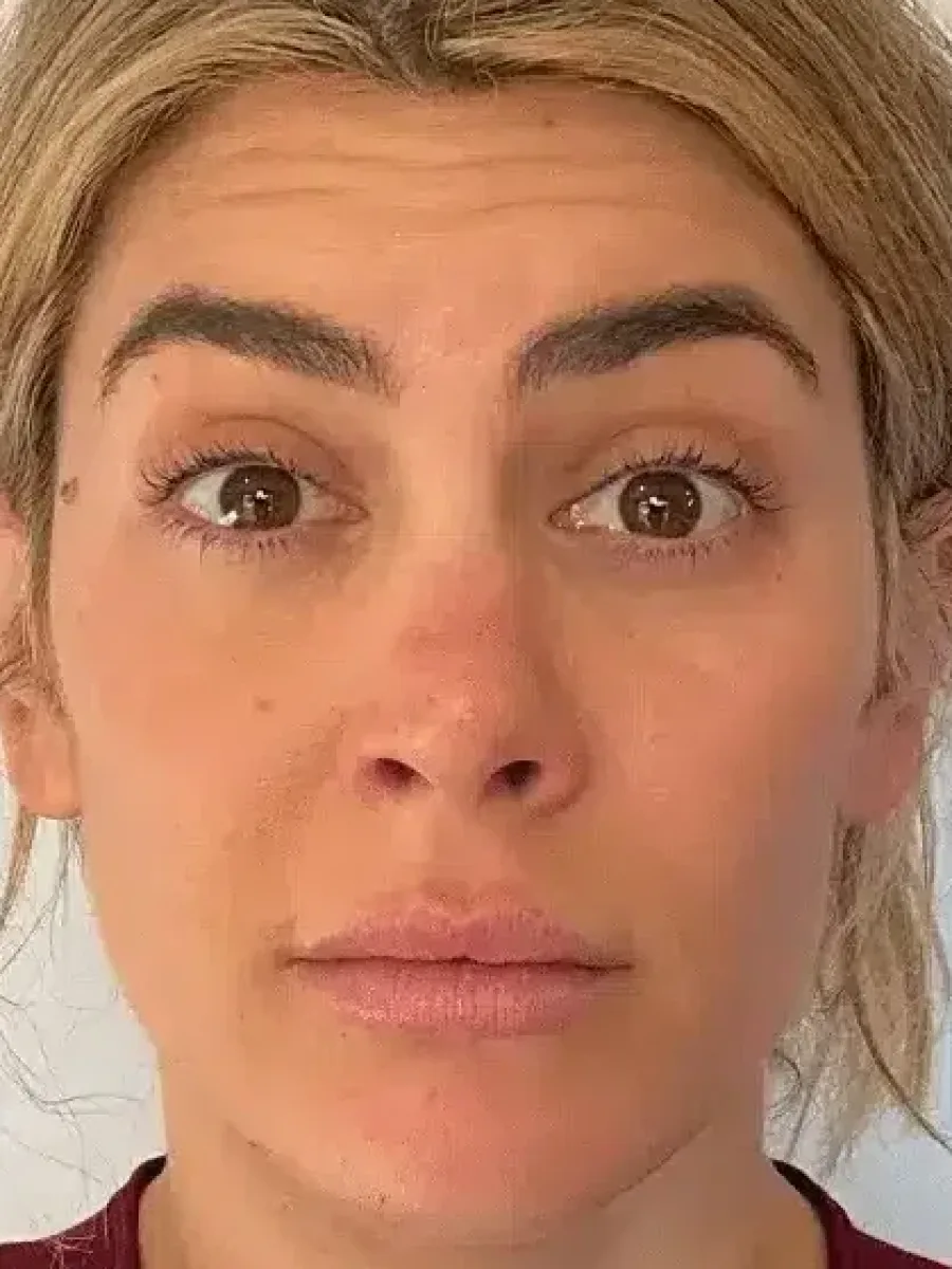 Natural Softening before — Esthetic Finesse