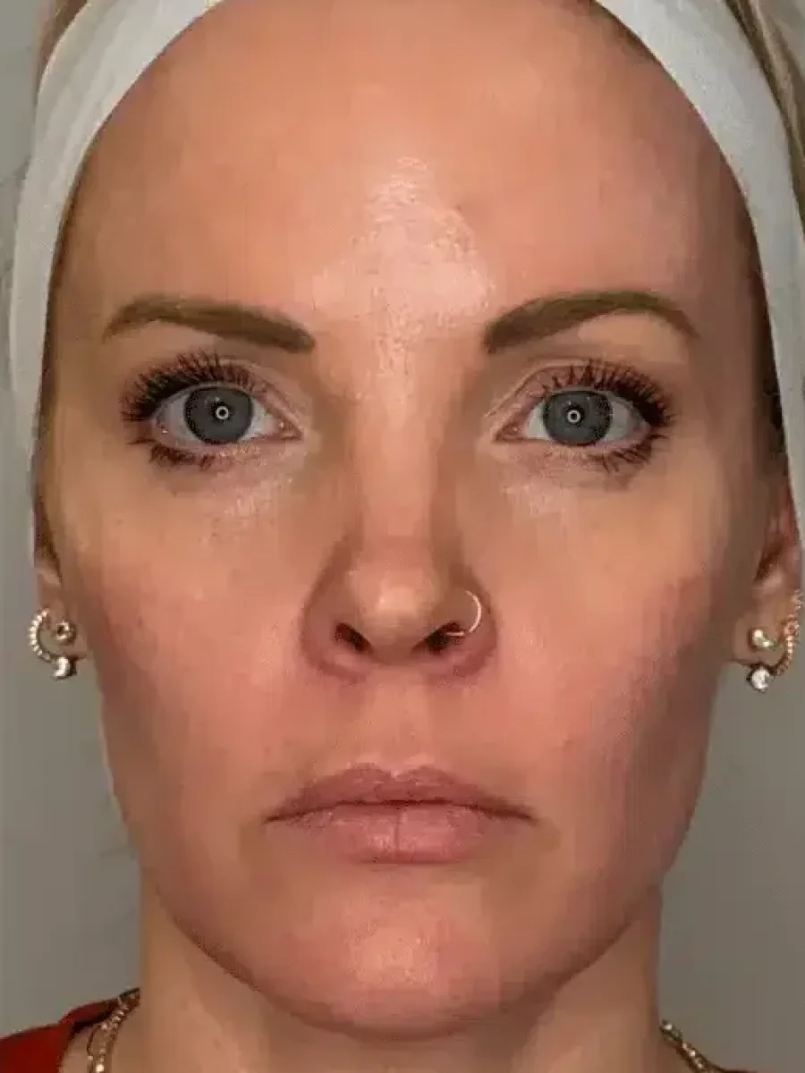 Facial Balancing before — Esthetic Finesse