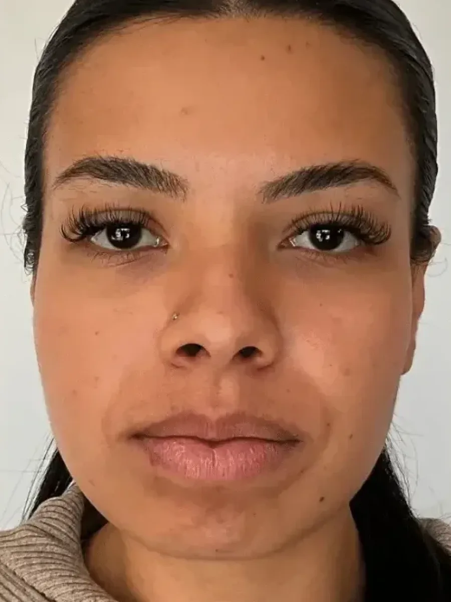 Full-Face Harmonization before — Esthetic Finesse