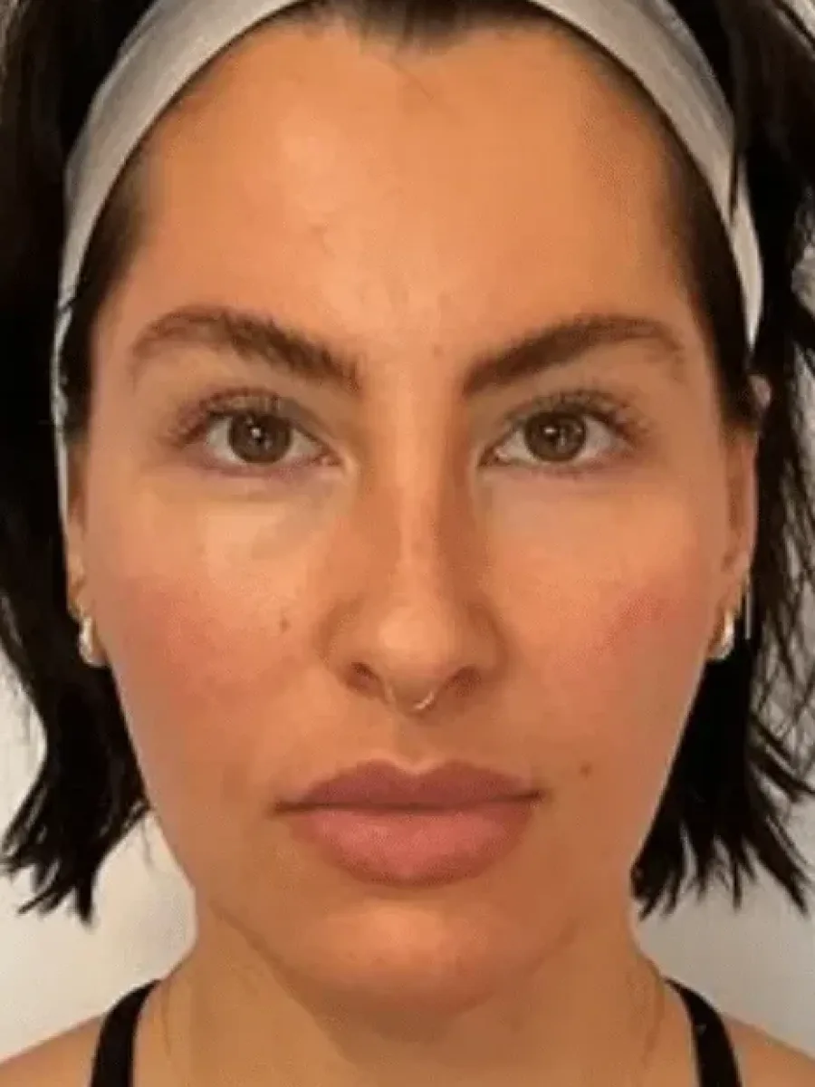 Cheek Contour after — Esthetic Finesse