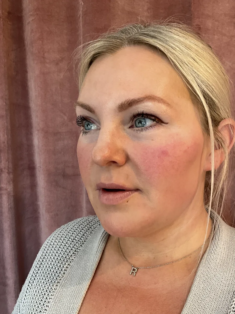 Full-Face Balancing & Jawline Creation with Radiesse before — Esthetic Finesse