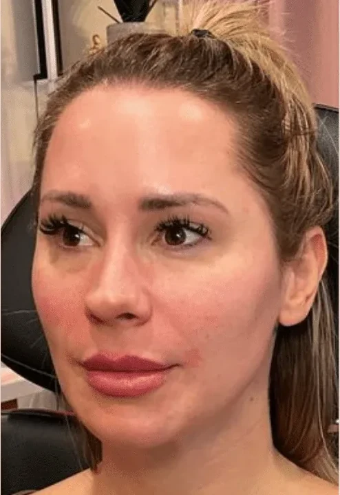 Collagen Restoration after — Esthetic Finesse