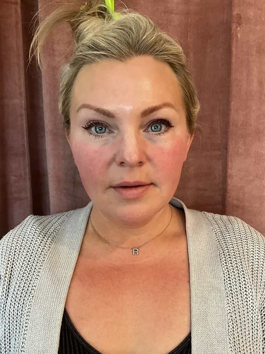 Collagen Restoration before — Esthetic Finesse