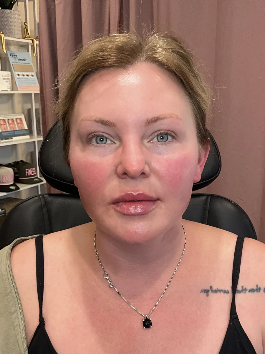 Collagen Restoration after — Esthetic Finesse