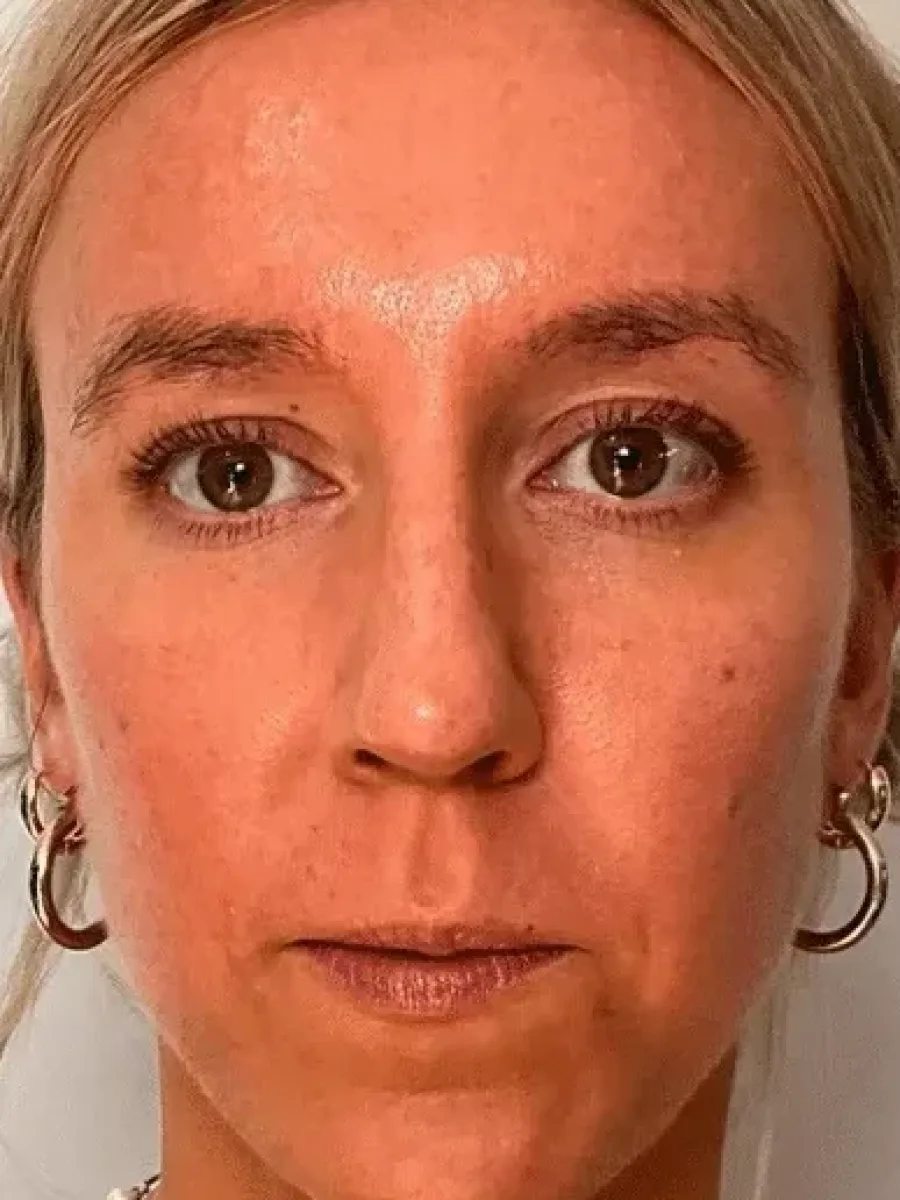 Full-Face Firmness after — Esthetic Finesse