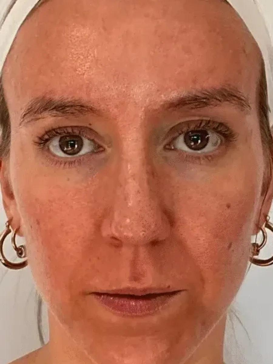 Full-Face Firmness before — Esthetic Finesse