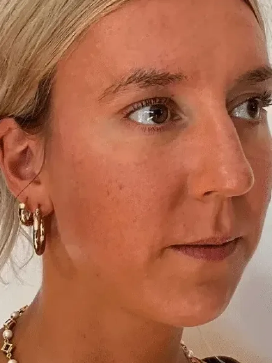 Natural Volume after — Esthetic Finesse