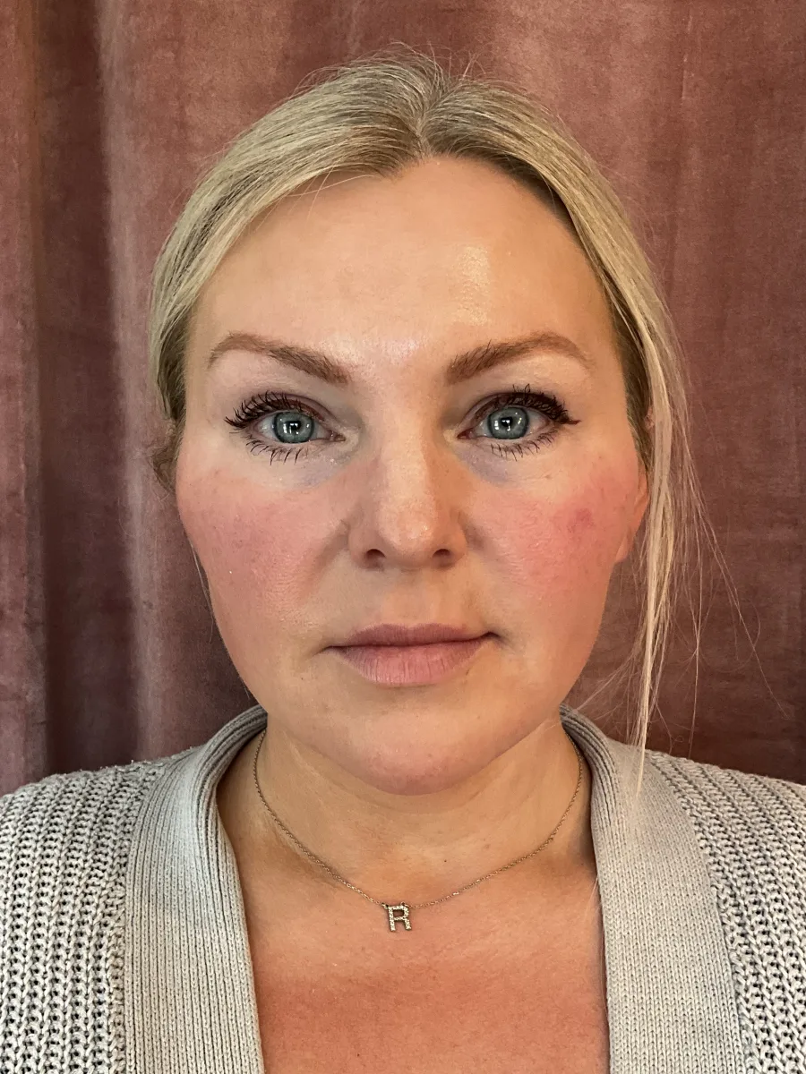 Full-Face Balancing with Sculptra after — Esthetic Finesse